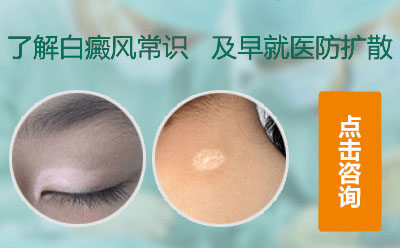 兒童白癜風，白癜風治療
